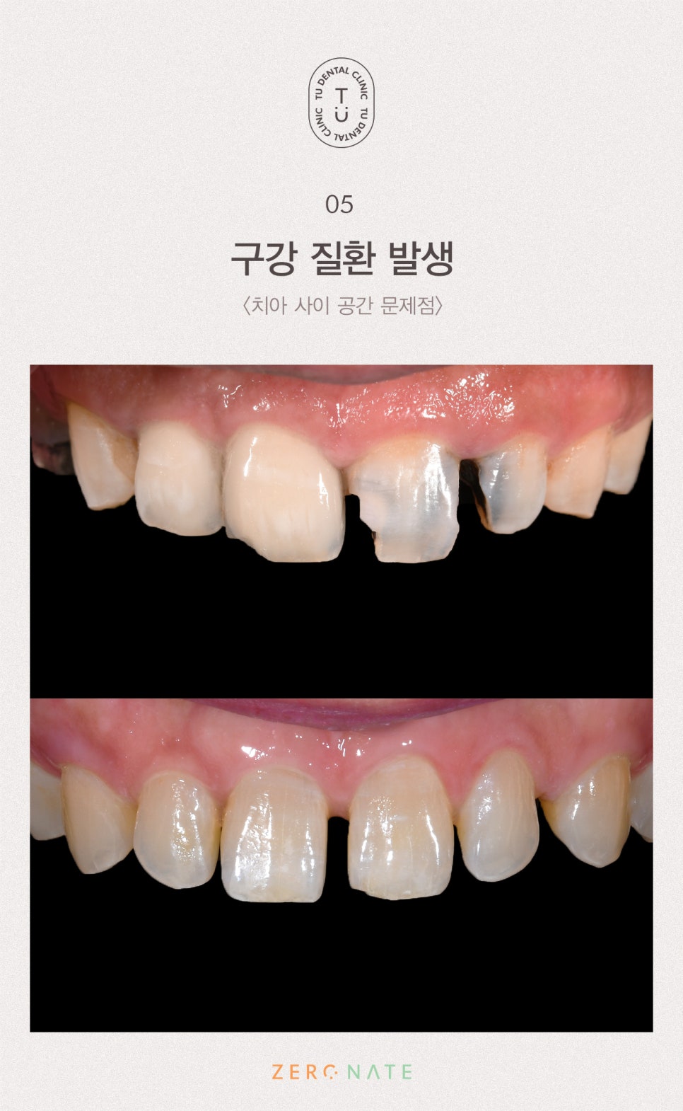치아 사이 공간 치료방법, 티유치과[TU치과] 관련 이미지 6