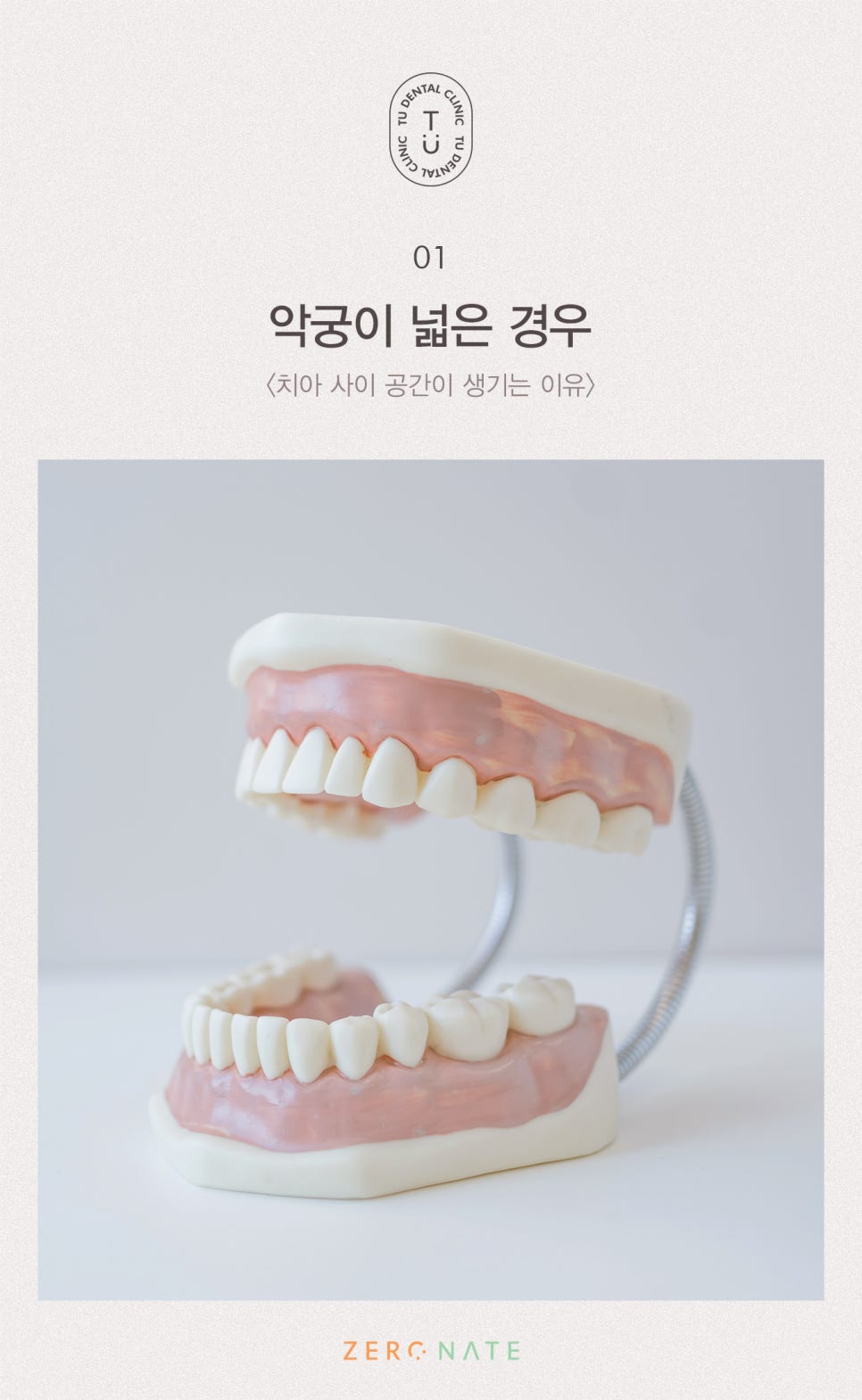 치아 사이 공간 치료방법, 티유치과[TU치과] 관련 이미지 2