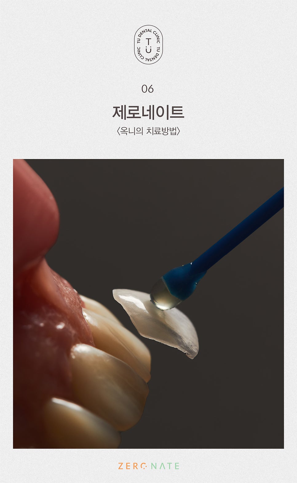 티유치과 옥니 치료법, 옥니에도 제로네이트 [TU치과] 관련 이미지 7