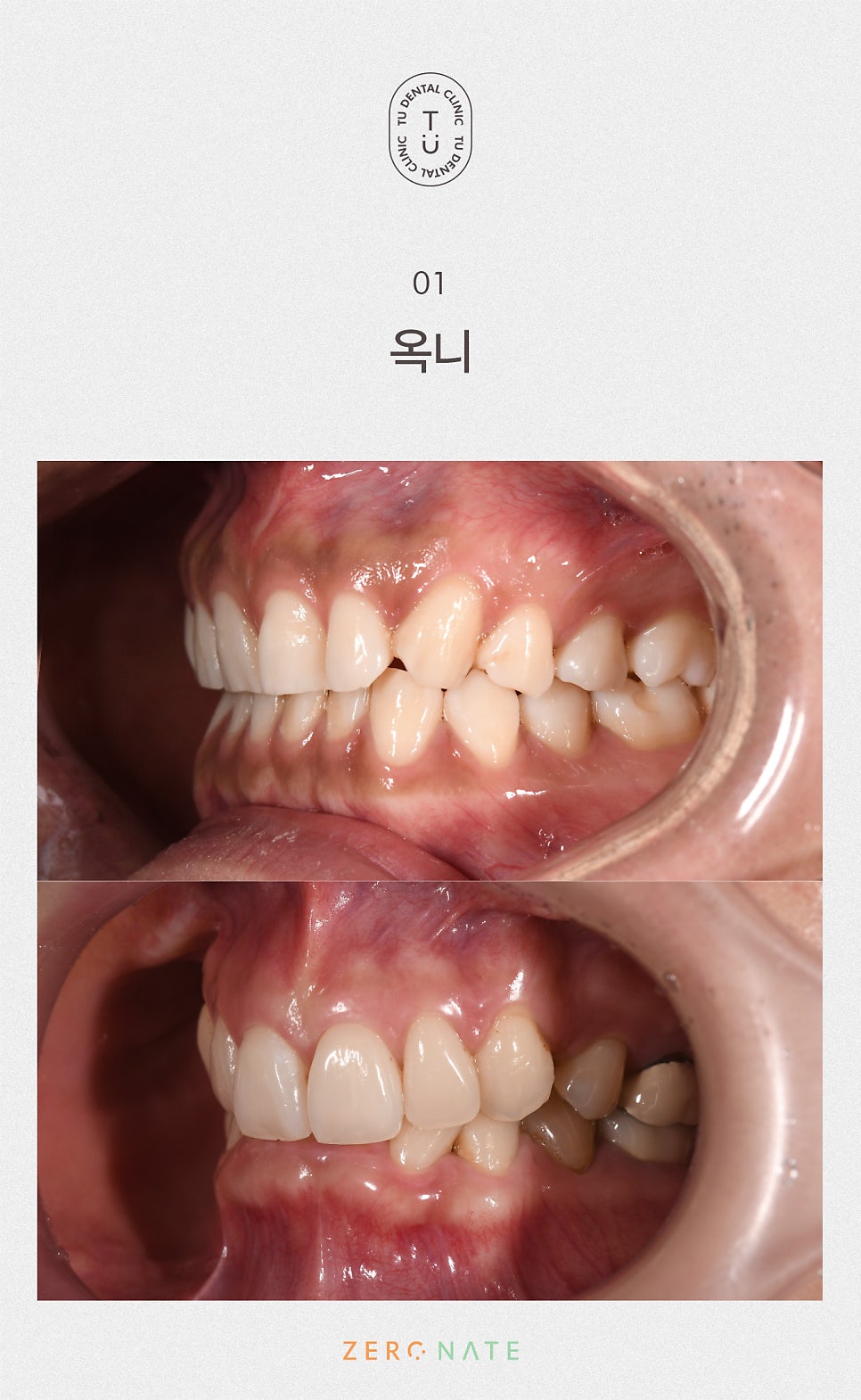 티유치과 옥니 치료법, 옥니에도 제로네이트 [TU치과] 관련 이미지 2