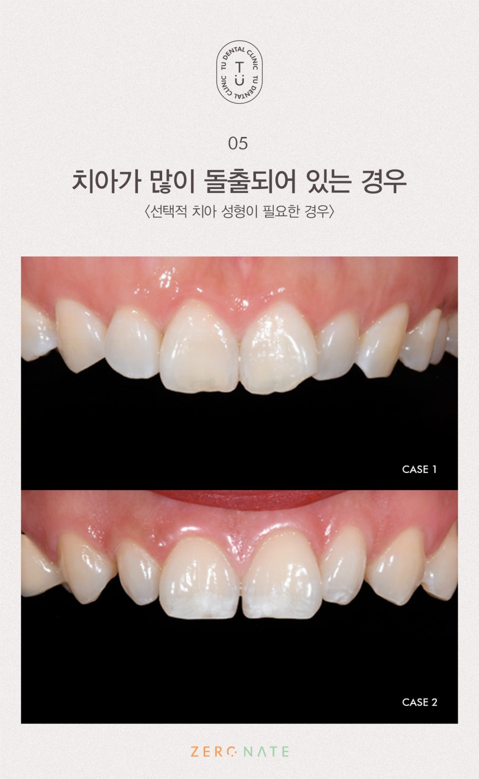 티유치과 선택적 치아 성형 [TU치과] 관련 이미지 6