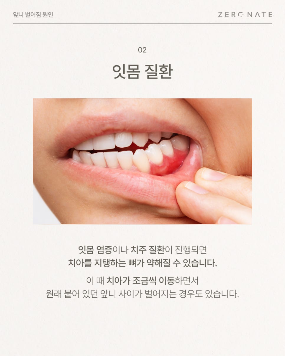 앞니벌어짐 원인부터 치료 방법 총정리 (레진, 라미네이트, 교정) 관련 이미지 3