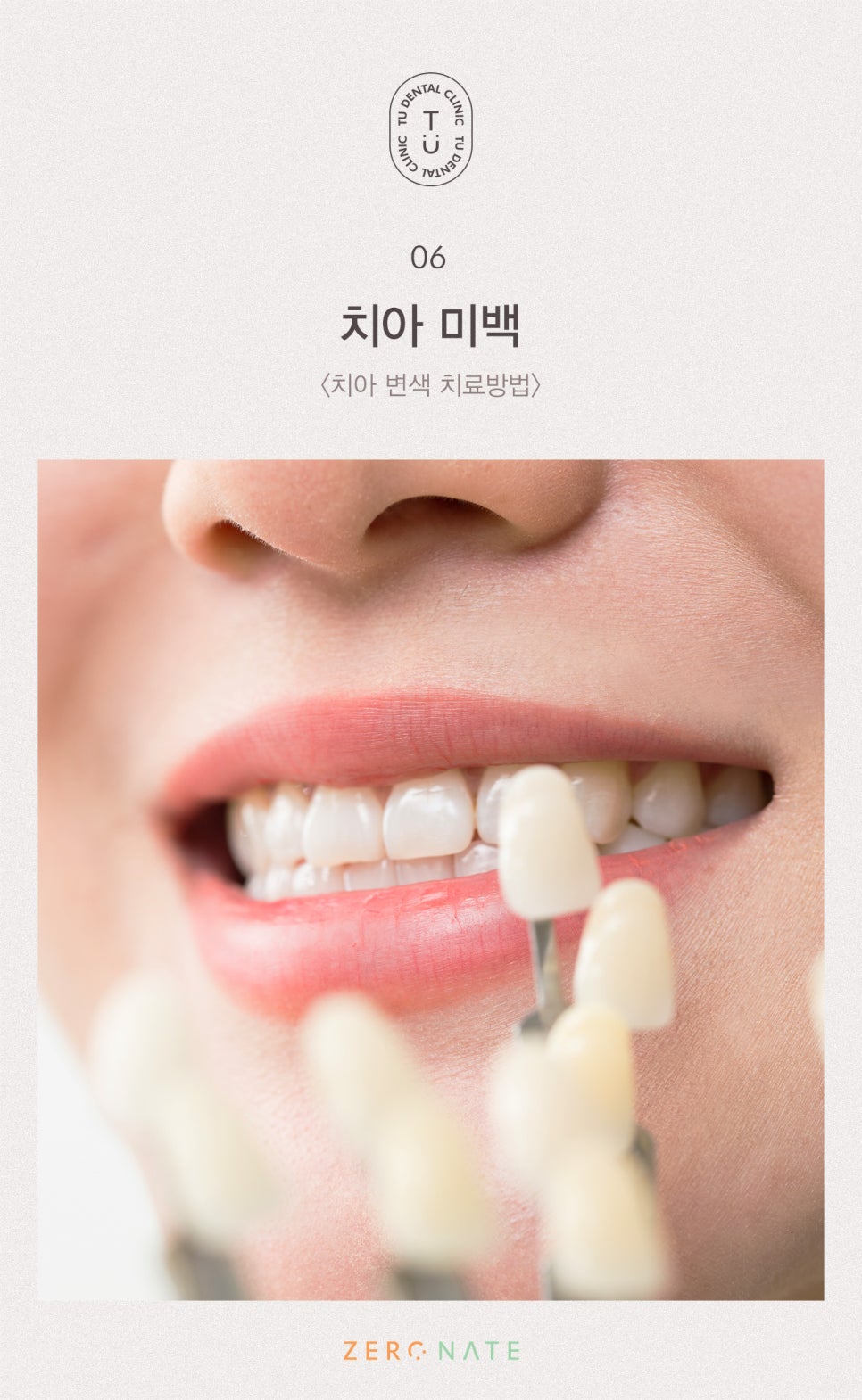 변색된 치아 치료방법, 티유치과 제로네이트 [TU치과] 관련 이미지 7