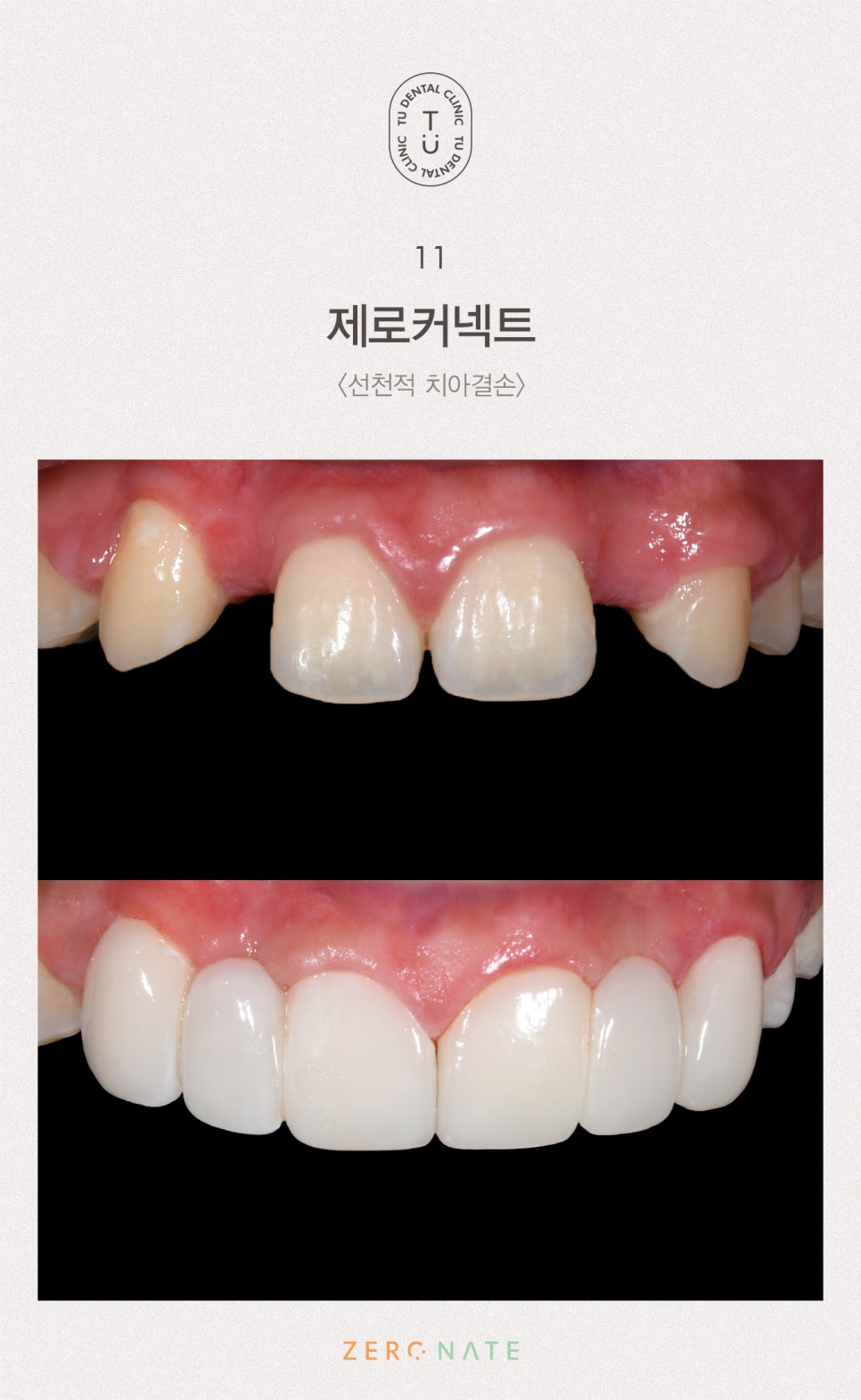 치아 사이 공간 치료방법, 티유치과[TU치과] 관련 이미지 12