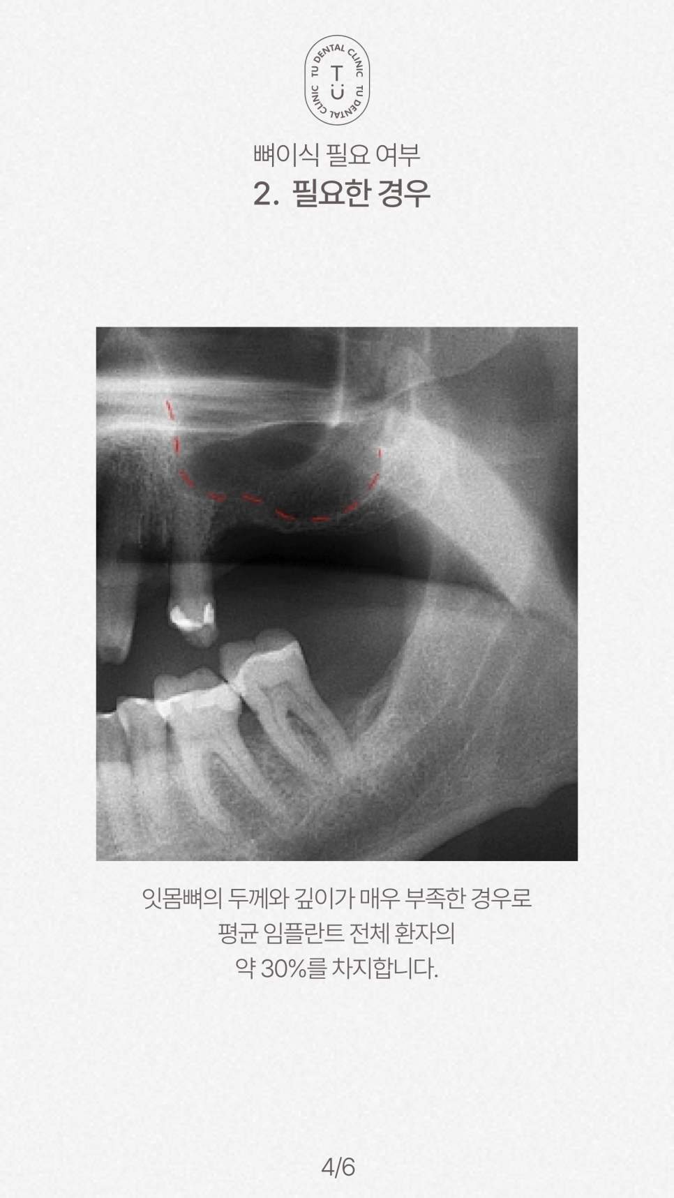 임플란트 뼈이식 꼭 해야할까요? 티유치과[TU치과] 관련 이미지 5