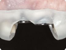 [TU치과/티유치과]임플란트 관련 이미지 2