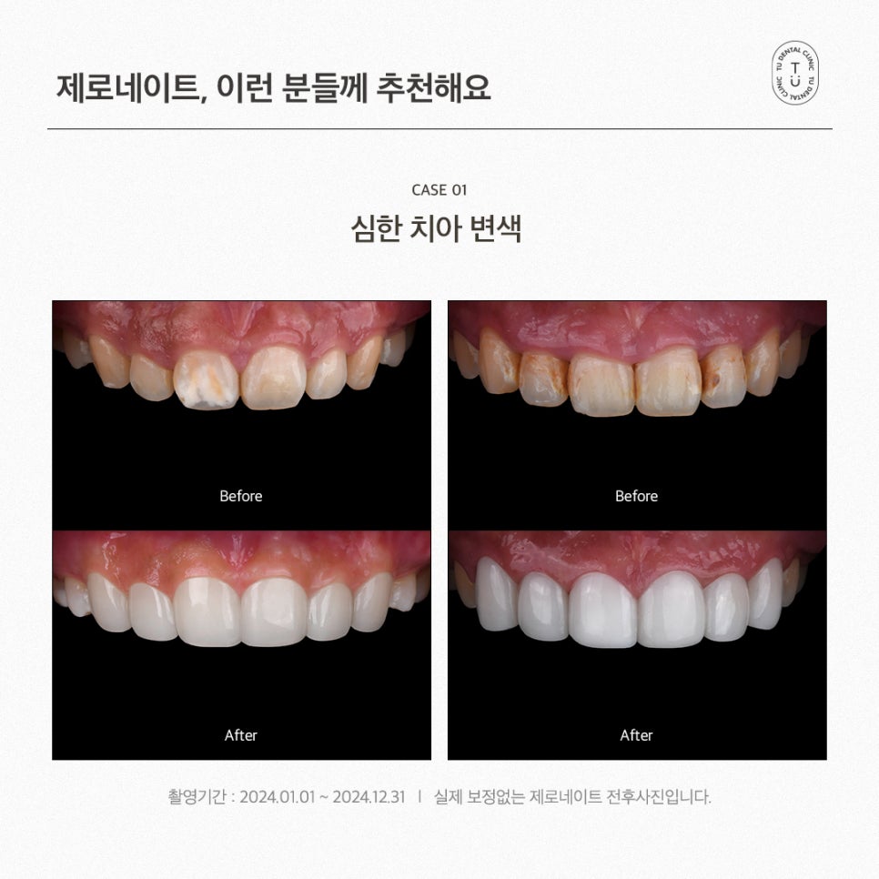 내 치아도 제로네이트 될까? (제로네이트 후기) 관련 이미지 5