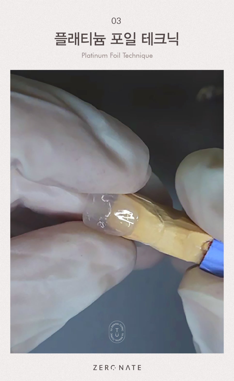 티유치과 제로네이트가 무삭제로 가능한 이유 알려드립니다 [TU치과] 관련 이미지 4