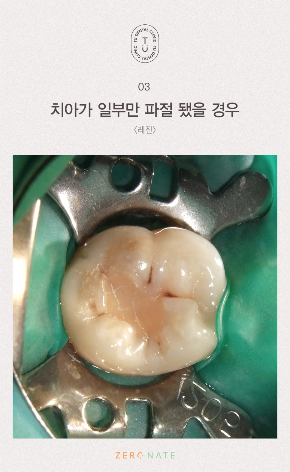 파절된 치아 치료방법, 티유치과[TU치과] 관련 이미지 4