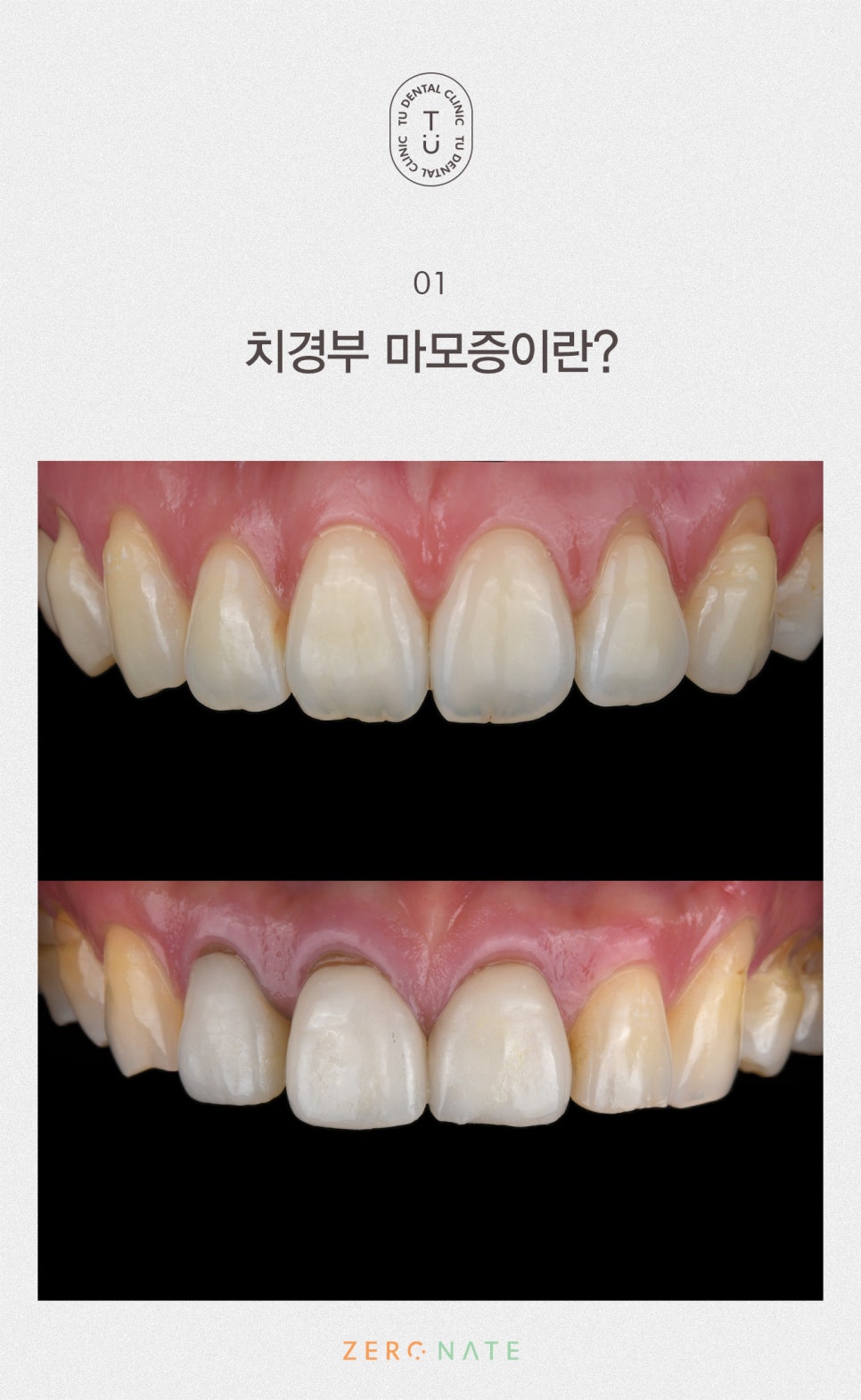 치경부 마모증 치료방법, 티유치과 제로네이트[TU치과] 관련 이미지 2