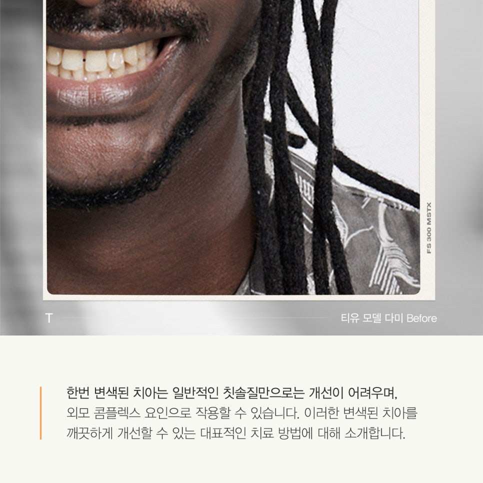 티유치과 6월 매거진, 변색된 치아의 치료법 [TU치과] 관련 이미지 3