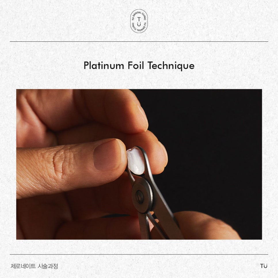 티유치과 제로네이트 시술과정 [TU치과] 관련 이미지 6