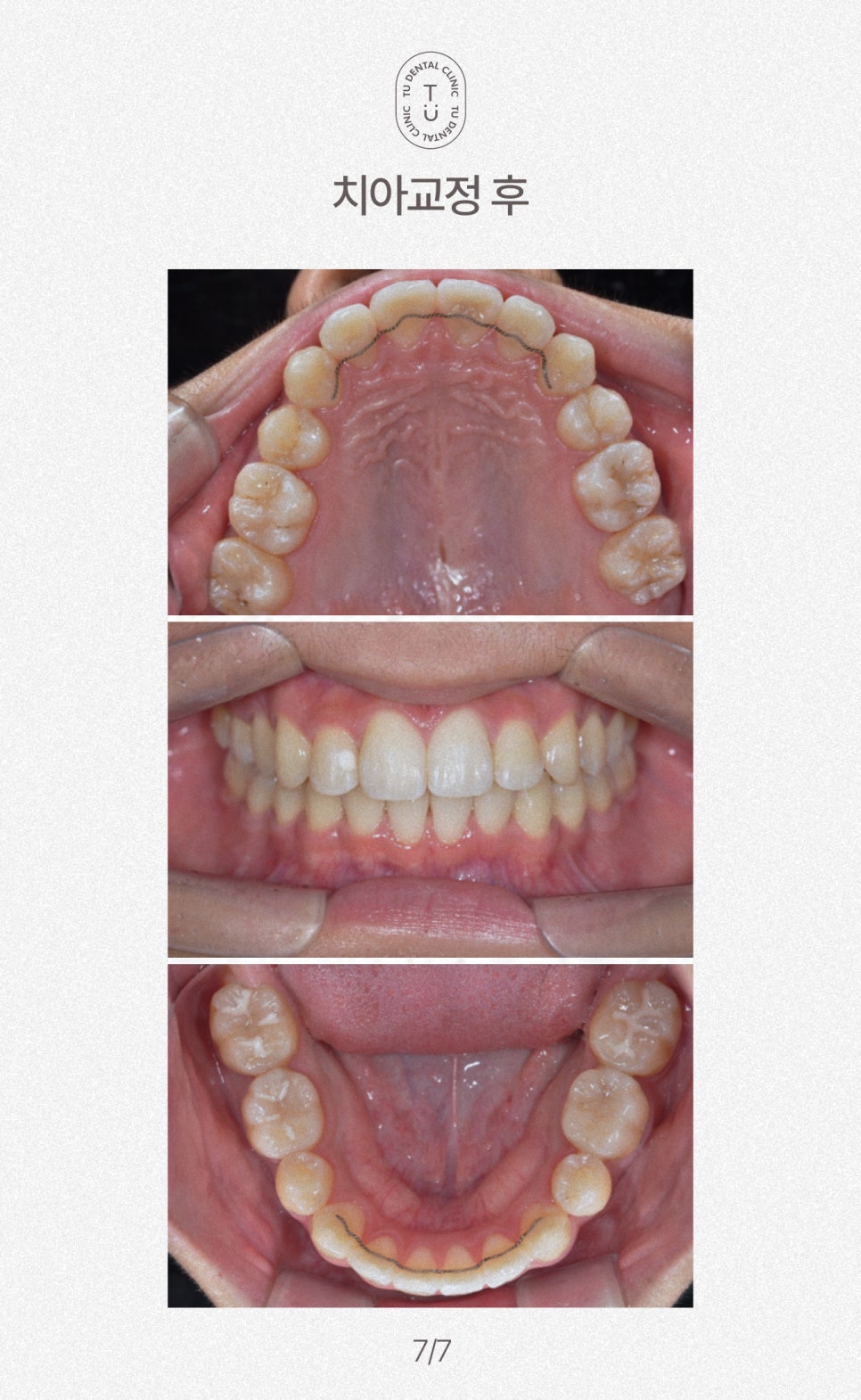 철도의 날, 삐뚤빼뚤한 치아에 철도공사하세요! 티유치과[TU치과] 관련 이미지 8