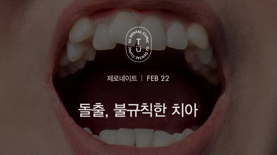 티유치과 돌출,불규칙한 치아 제로네이트[TU치과] 관련 이미지 1