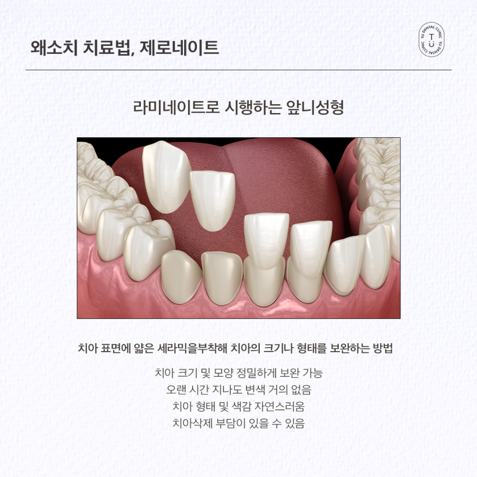 왜소치 라미네이트 제로네이트 자연스러운 미소를 되찾는 앞니성형 관련 이미지 4