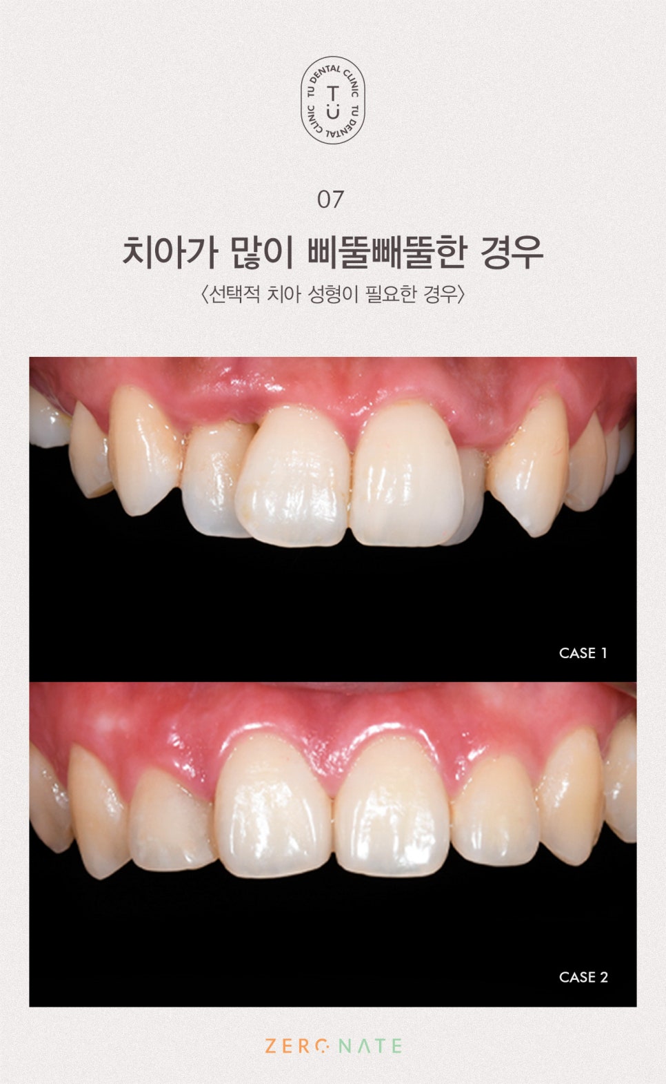 티유치과 선택적 치아 성형 [TU치과] 관련 이미지 8