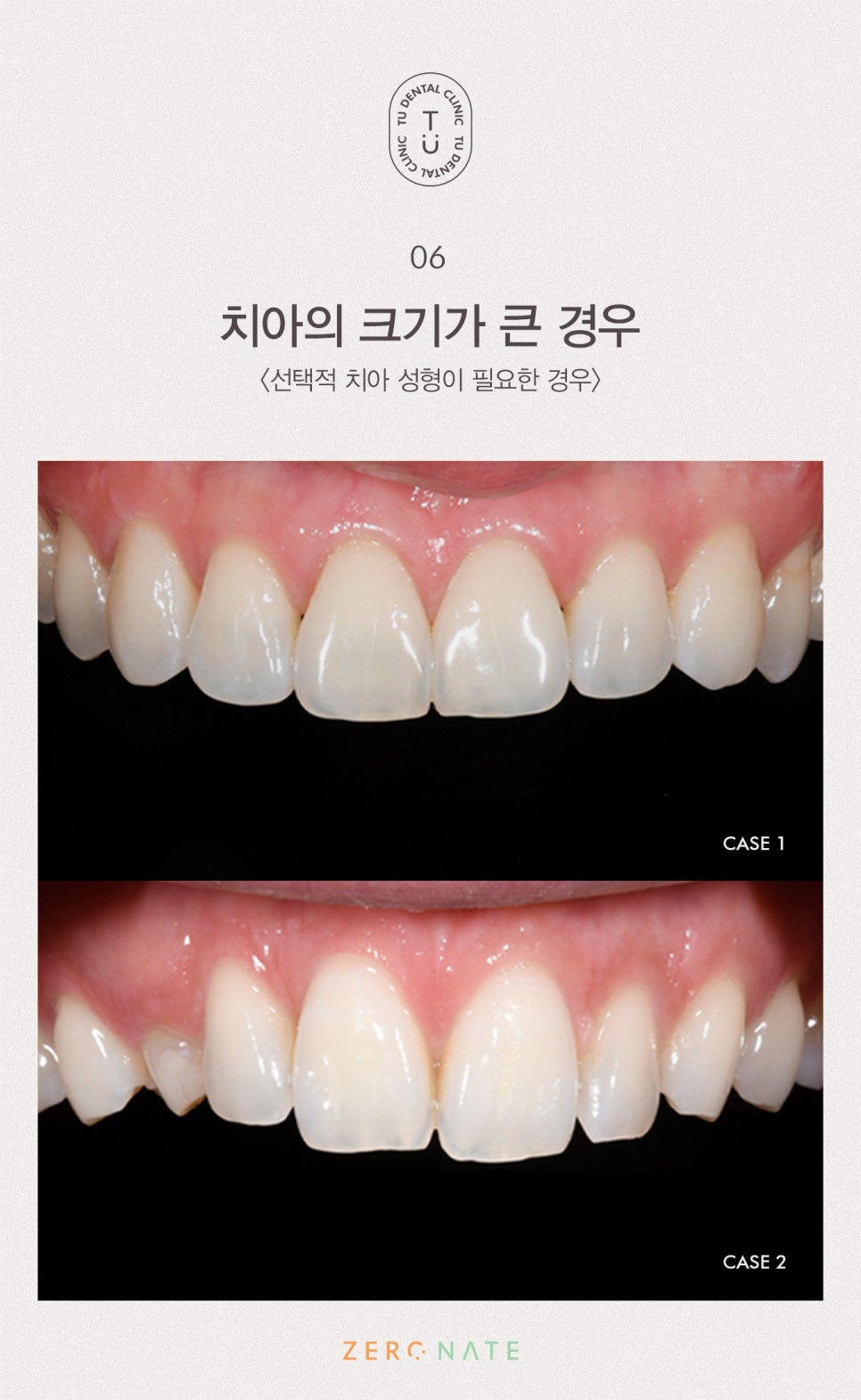 티유치과 선택적 치아 성형 [TU치과] 관련 이미지 7