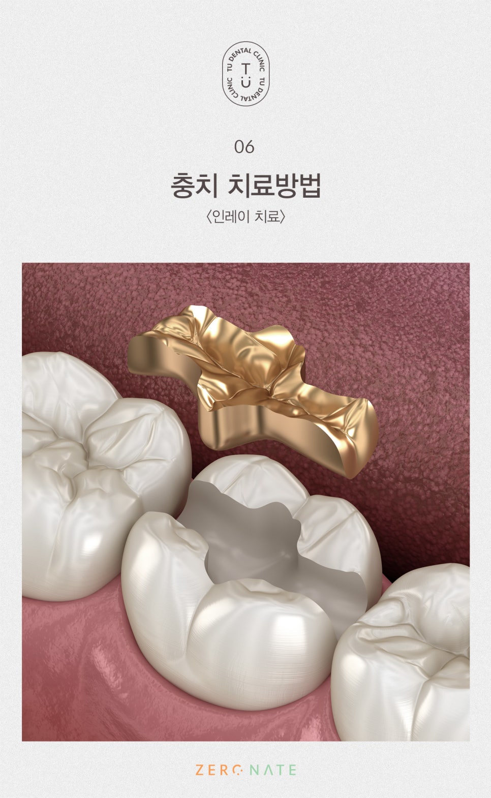 충치의 개선 제로네이트[TU치과] 관련 이미지 7