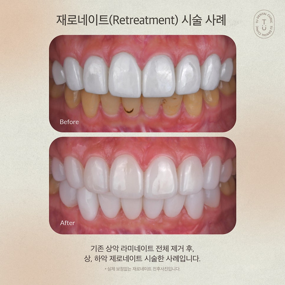 [티유치과] 기존 라미네이트를 제로네이트로 교체도 가능할까요?[TU치과] 관련 이미지 5