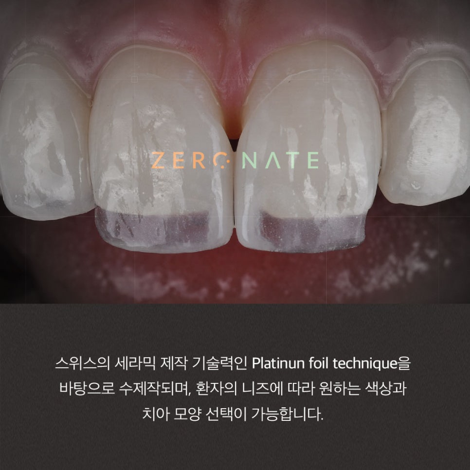 예신관리 BEST 웨딩시술 추천 (피부, 제로네이트) 관련 이미지 10