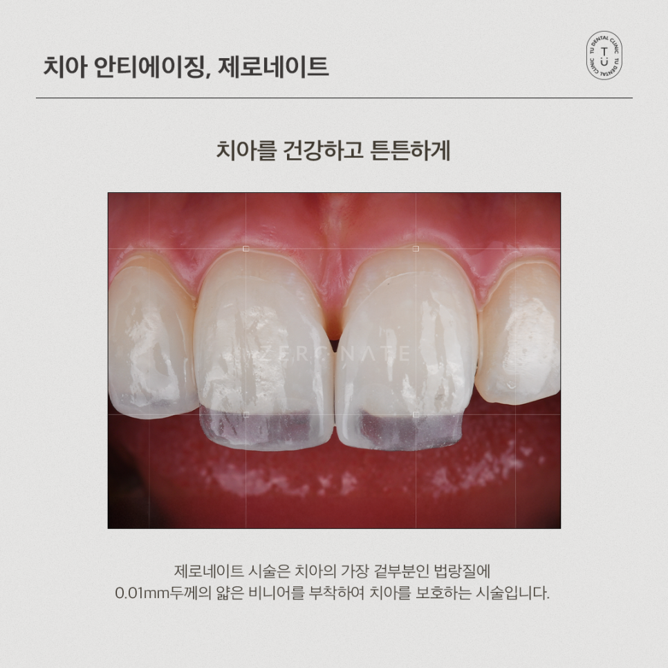 [티유치과] 안티에이징의 치료법, 제로네이트[TU치과] 관련 이미지 3