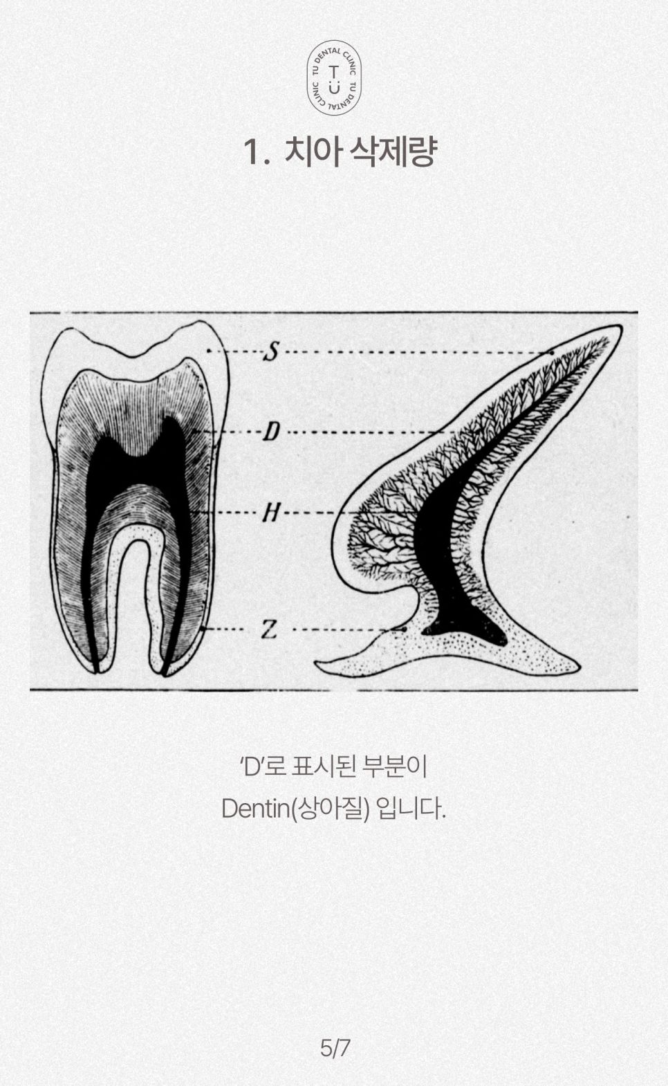 라미네이트 부작용, 떨어지는 이유 알려드립니다 관련 이미지 7