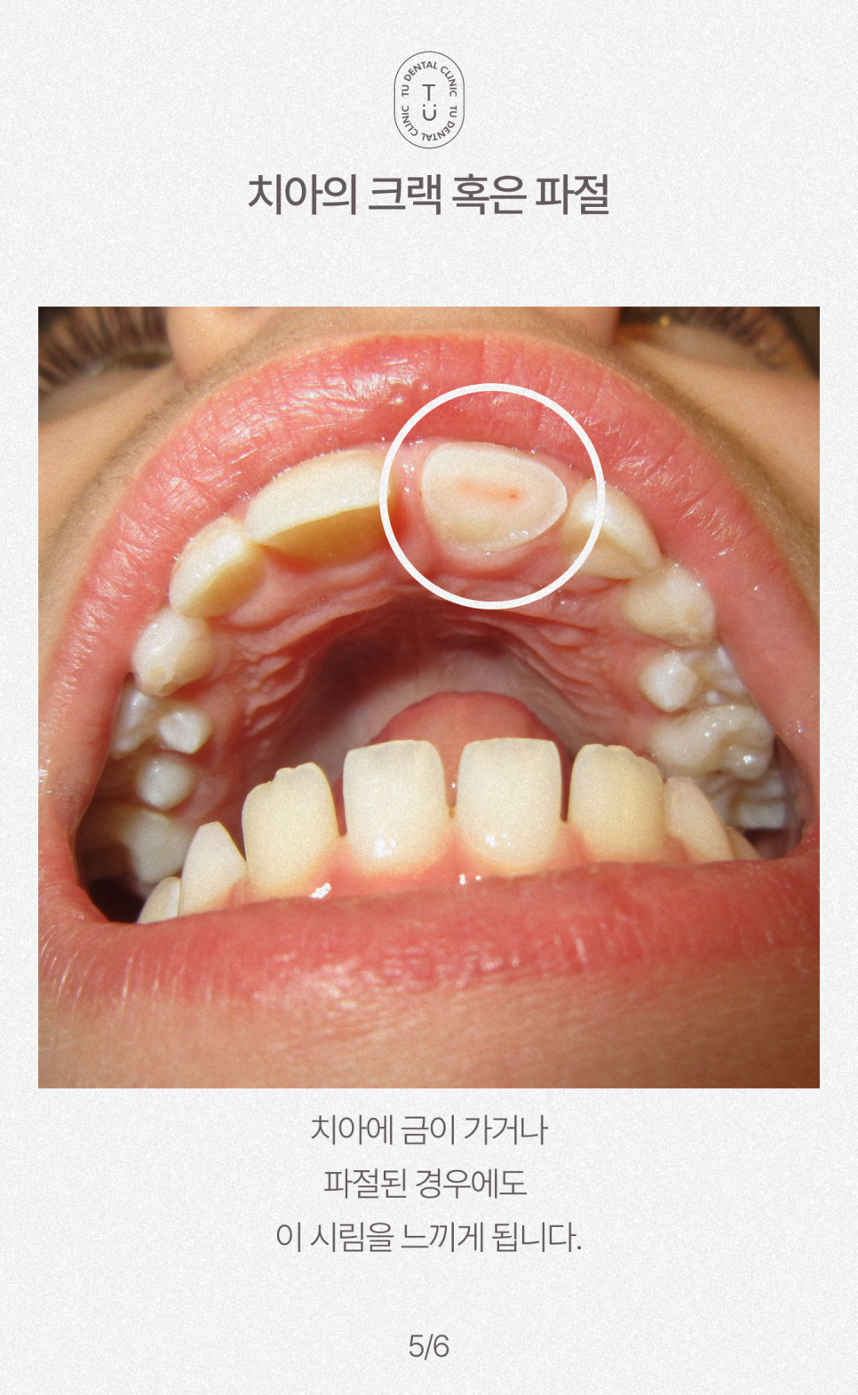 여름철, 이 시린이유가 뭘까요? 티유치과[TU치과] 관련 이미지 6