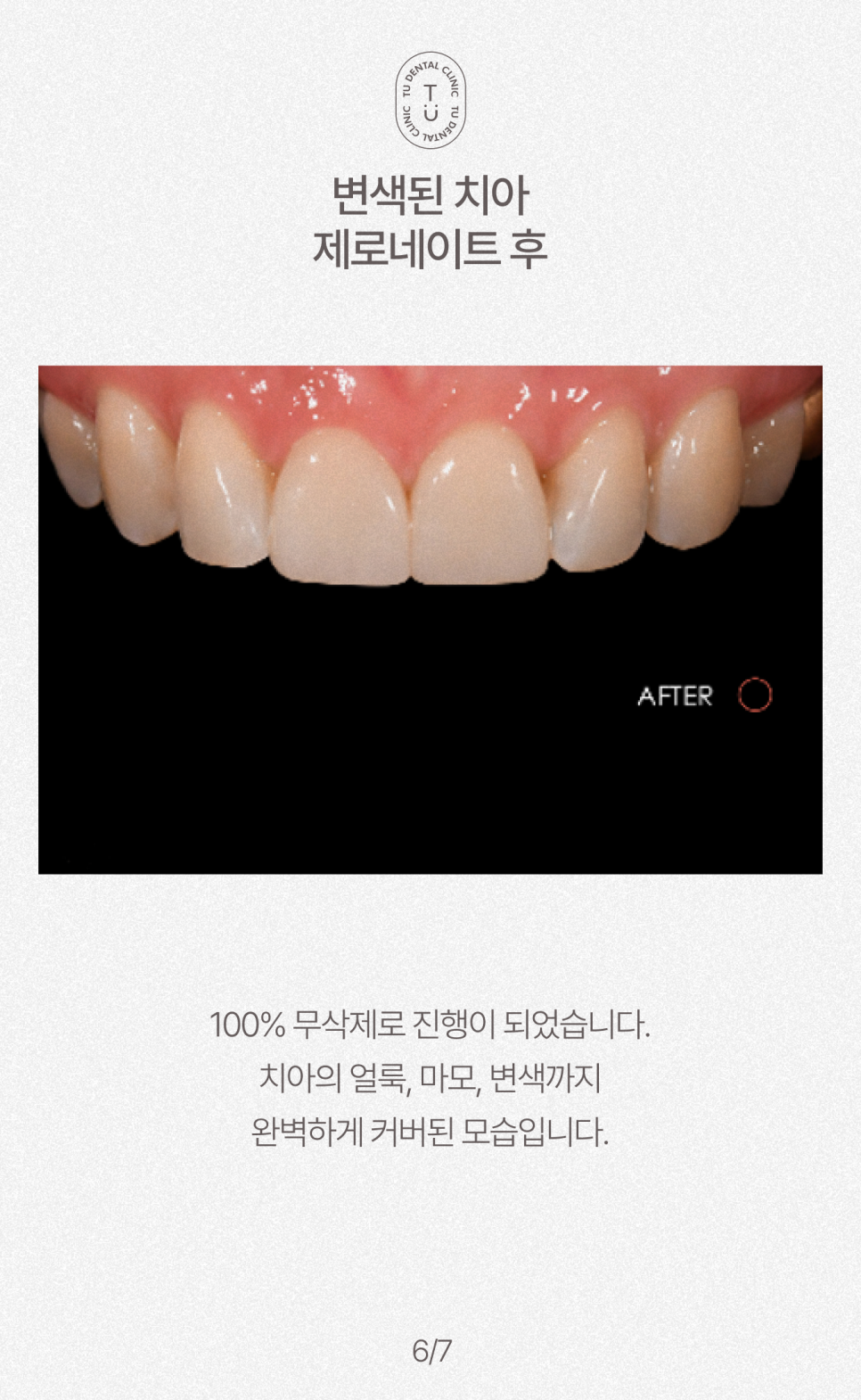 치아 반영구적으로 하얘지는 법, 티유치과[TU치과] 관련 이미지 7