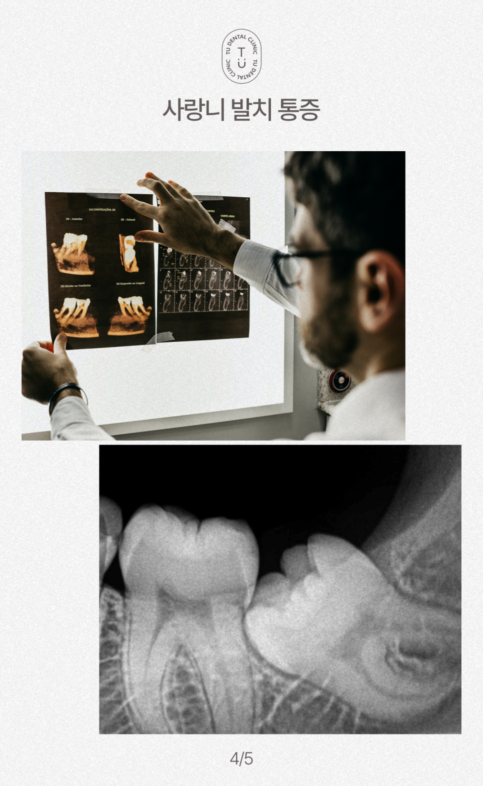 사랑니 안 아프게 발치하는 방법 알려드립니다, 티유치과[TU치과] 관련 이미지 5