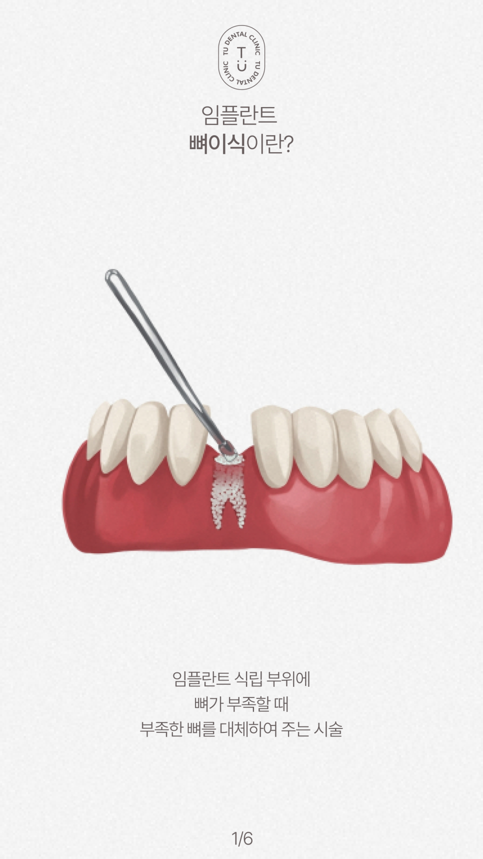 임플란트 뼈이식 꼭 해야할까요? 티유치과[TU치과] 관련 이미지 2