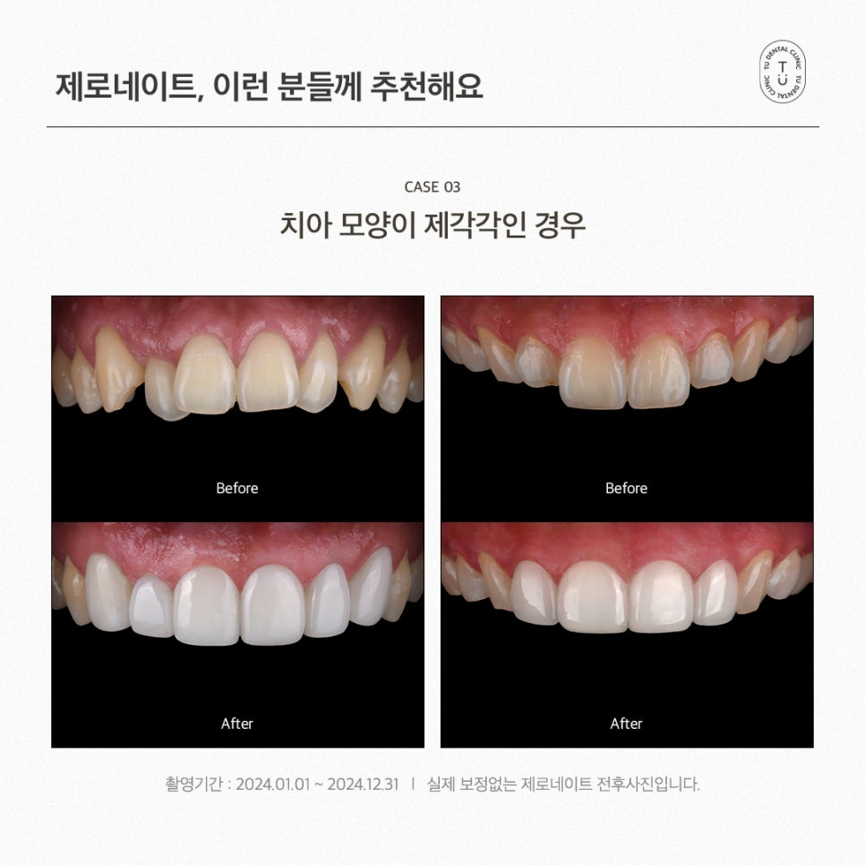 내 치아도 제로네이트 될까? (제로네이트 후기) 관련 이미지 7