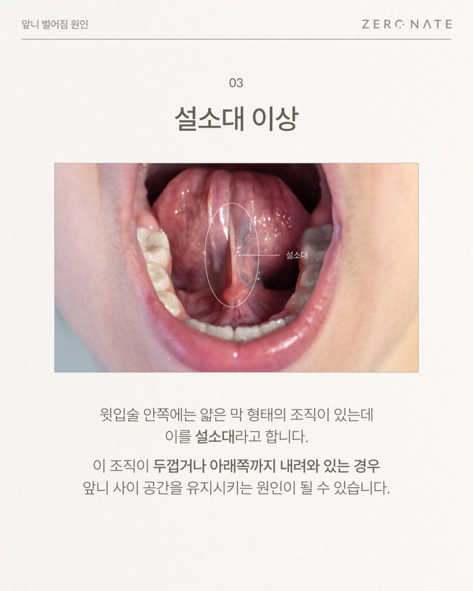 앞니벌어짐 원인부터 치료 방법 총정리 (레진, 라미네이트, 교정) 관련 이미지 4