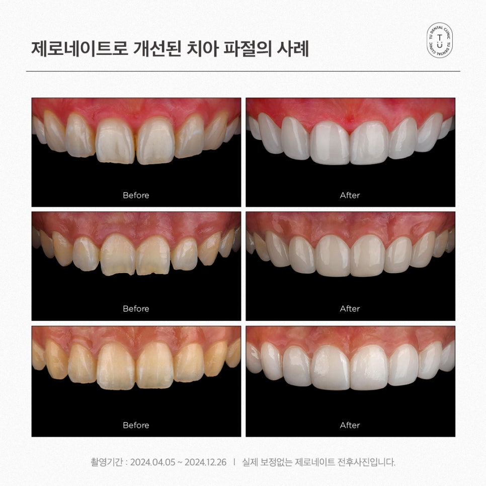 [티유치과] 치아 파절의 치료법, 제로네이트 관련 이미지 7