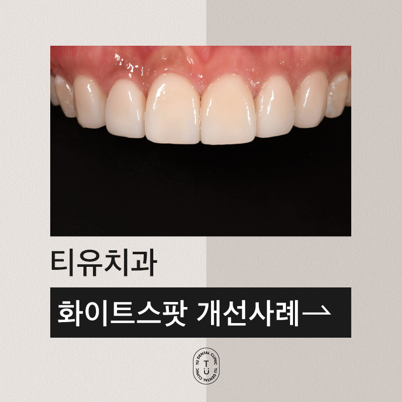 화이트스팟(white spot) 보완 case : 제로네이트 관련 이미지 1