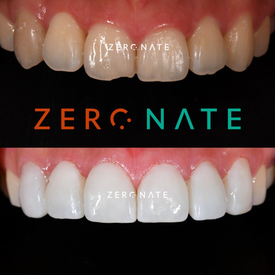 깨진 앞니 치료 제로네이트 사례 : 티유치과 관련 이미지 4