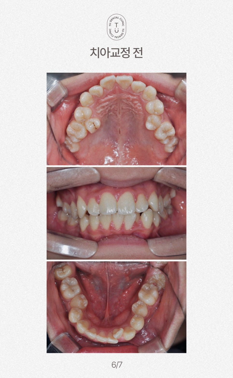 철도의 날, 삐뚤빼뚤한 치아에 철도공사하세요! 티유치과[TU치과] 관련 이미지 7