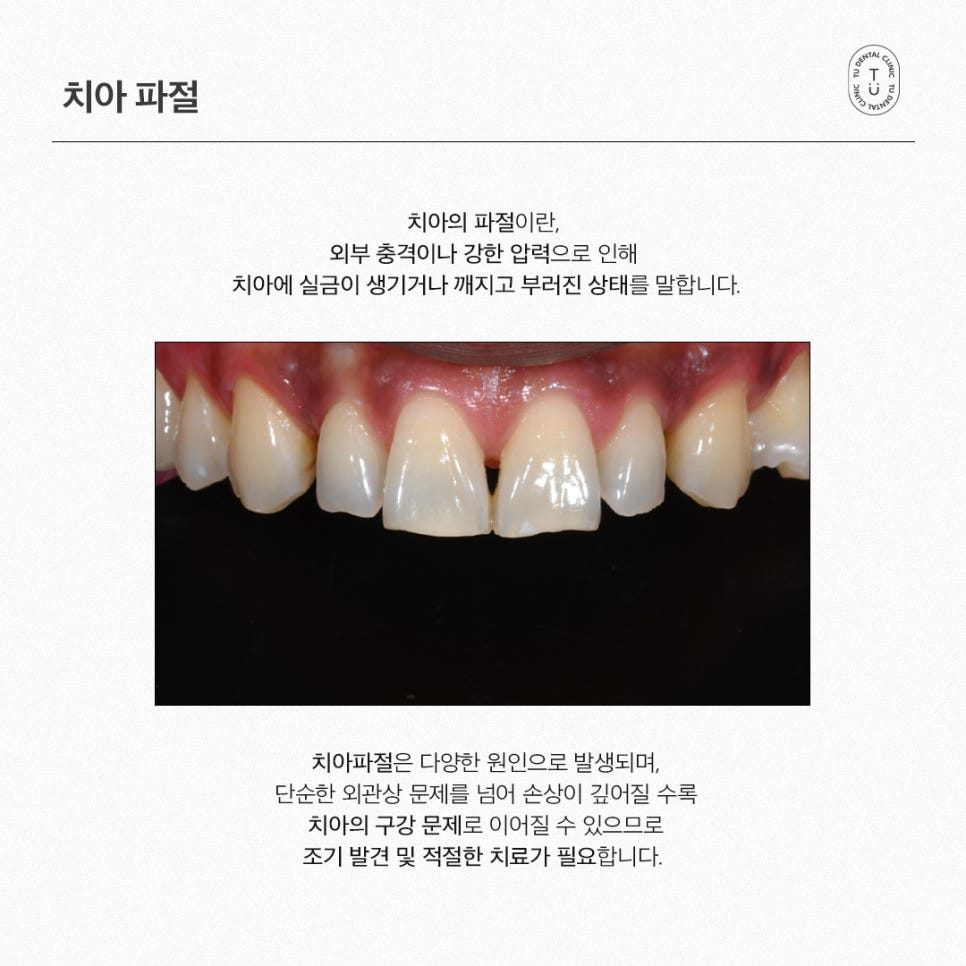 [티유치과] 치아 파절의 치료법, 제로네이트 관련 이미지 2