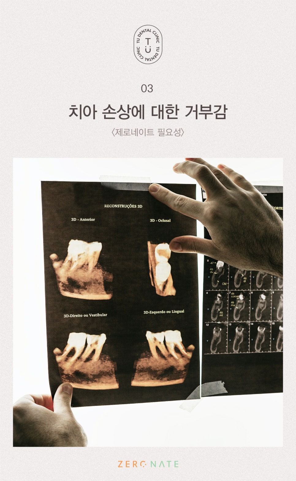 티유치과 제로네이트 가격 설명드립니다 [TU치과] 관련 이미지 4