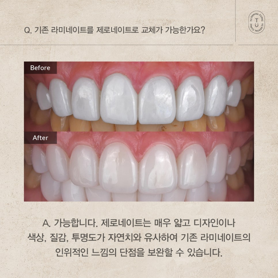 제로네이트 자주 묻는 질문 FAQ ｜ PART.2[TU치과] 관련 이미지 5