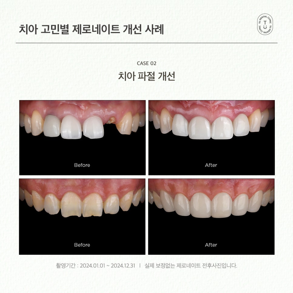 치아 고민별 제로네이트 개선 사례 (유형별 라미네이트 전후) 관련 이미지 5