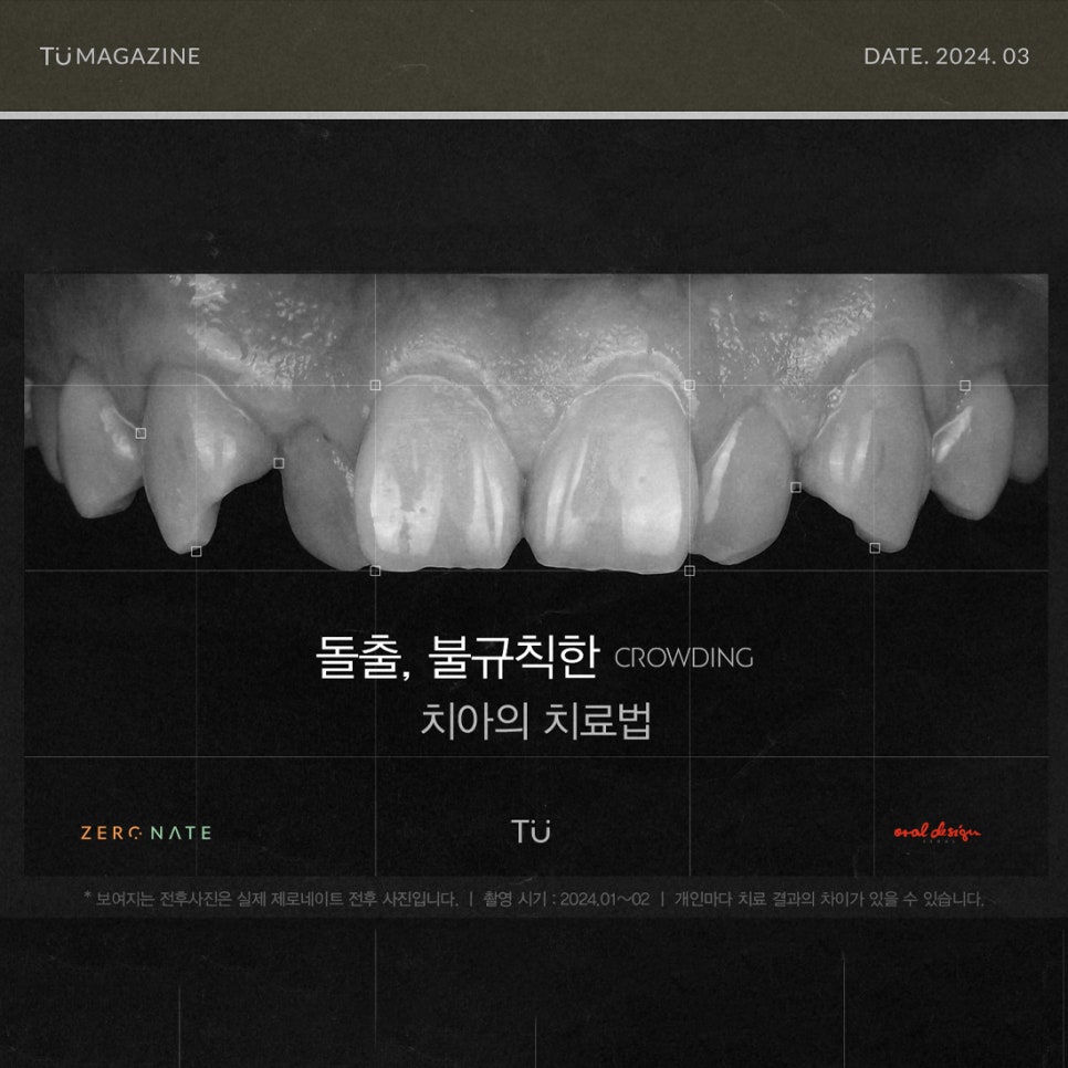 티유치과 3월 매거진 돌출, 불규칙한 치아의 치료법 [TU치과] 관련 이미지 1