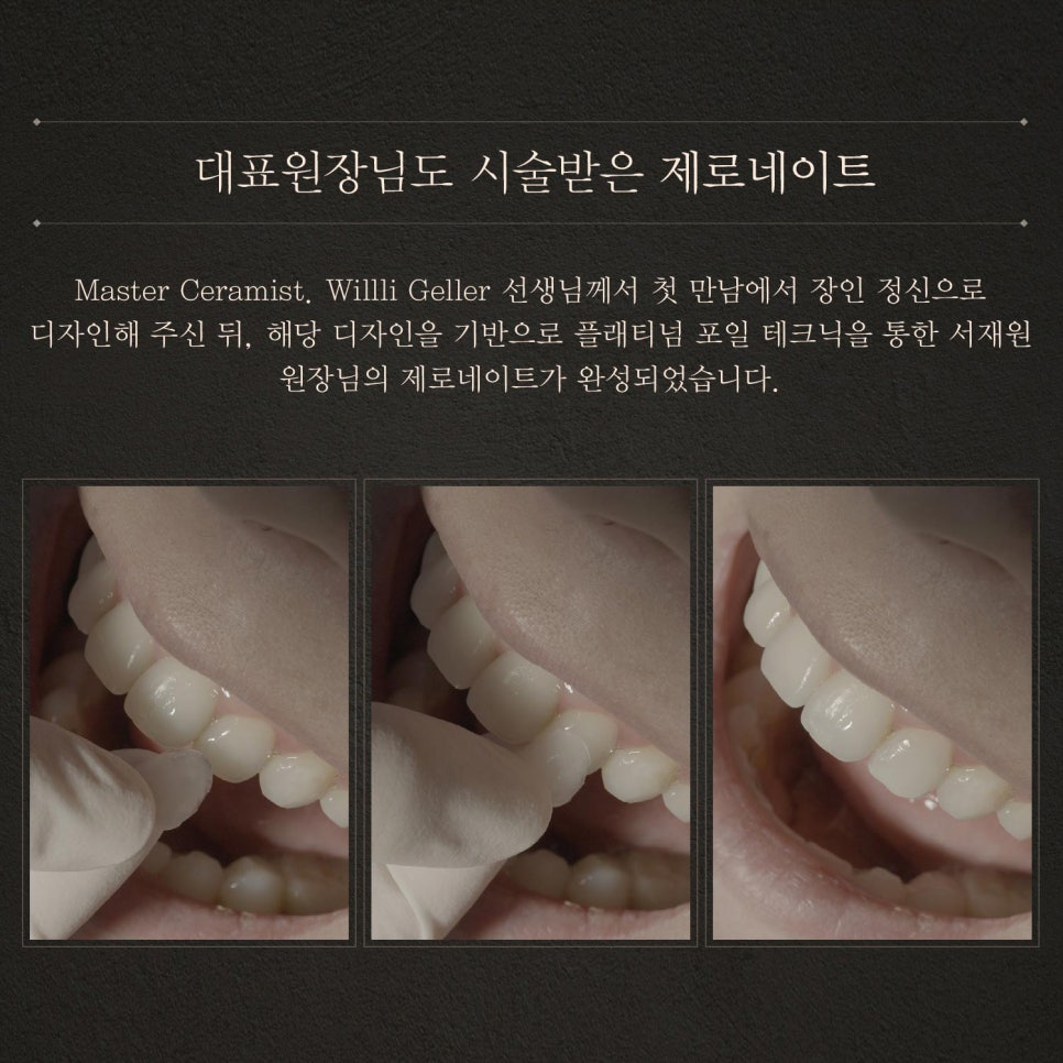 티유치과 8월 매거진, 대표원장님도 시술받은 제로네이트 [TU치과] 관련 이미지 7