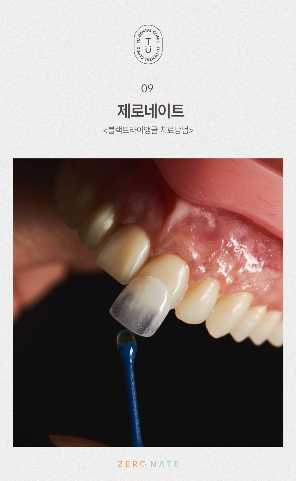 티유치과 블랙트라이앵글 제로네이트 [TU치과] 관련 이미지 10