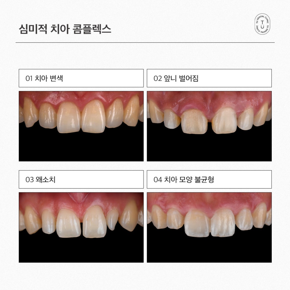 내 치아도 제로네이트 될까? (제로네이트 후기) 관련 이미지 2
