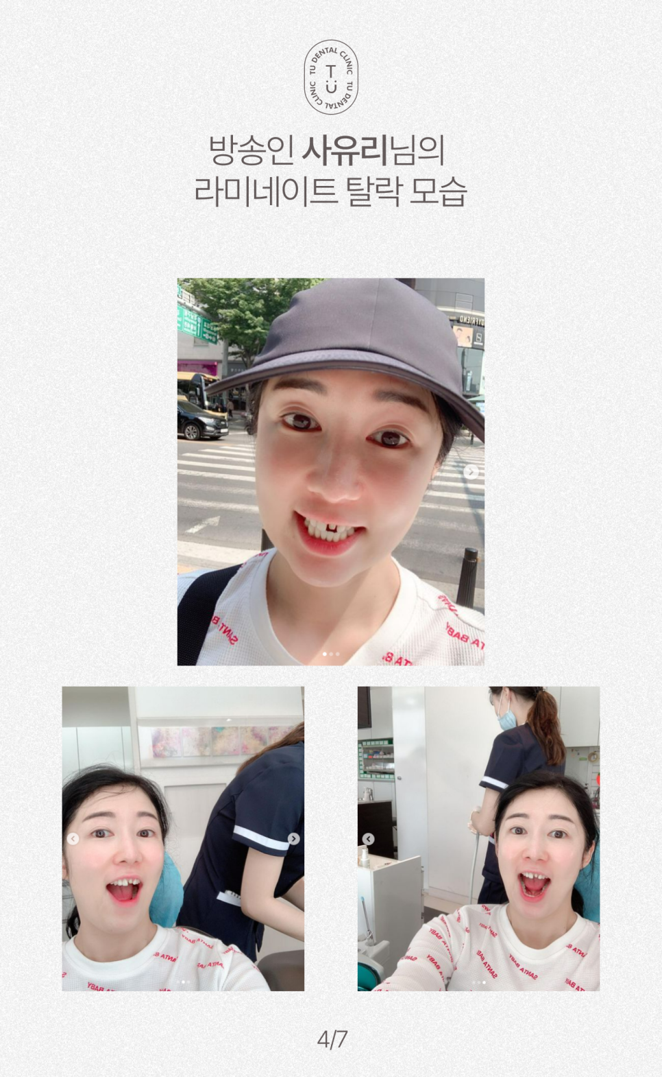 라미네이트 부작용, 떨어지는 이유 알려드립니다 관련 이미지 5