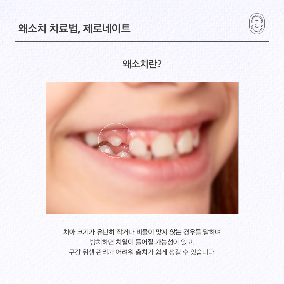 왜소치 라미네이트 제로네이트 자연스러운 미소를 되찾는 앞니성형 관련 이미지 2