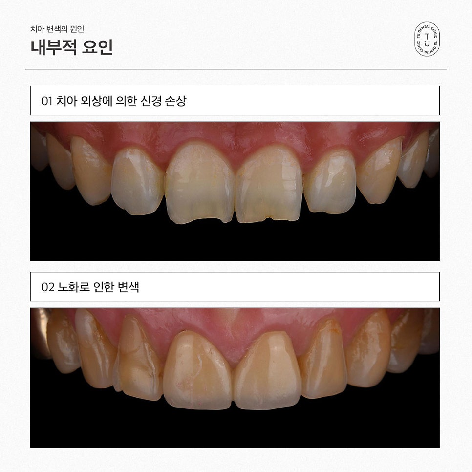 [티유치과] 치아미백으로 해결되지 않는 변색 치아의 치료법, 제로네이트 관련 이미지 3