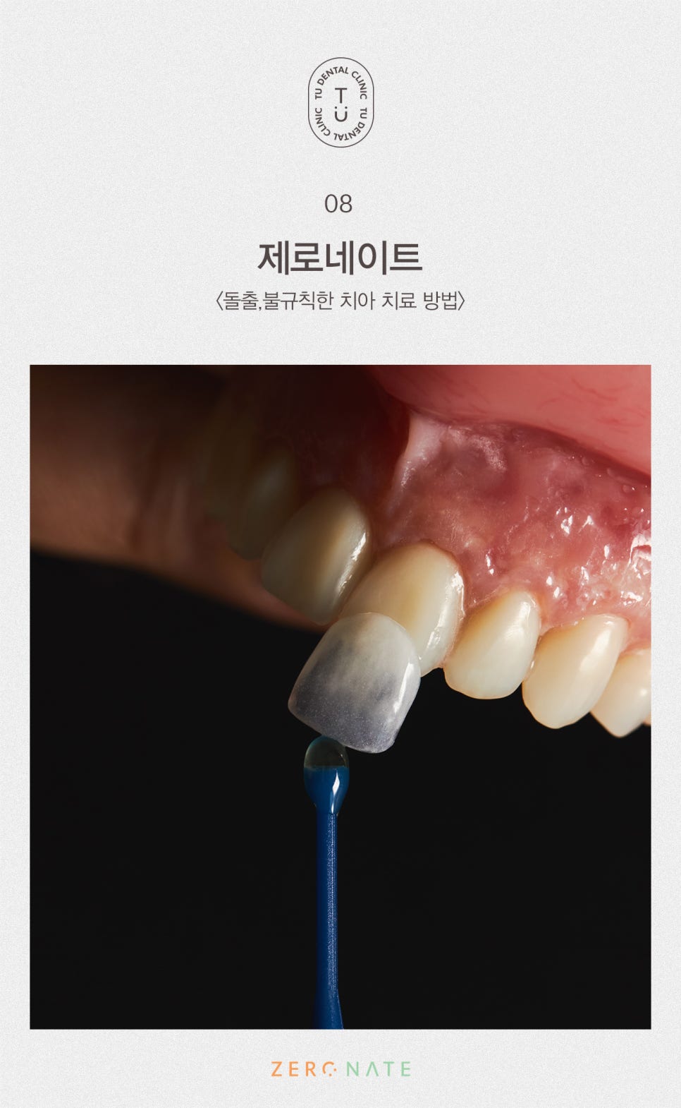 티유치과 돌출,불규칙한 치아 제로네이트[TU치과] 관련 이미지 9