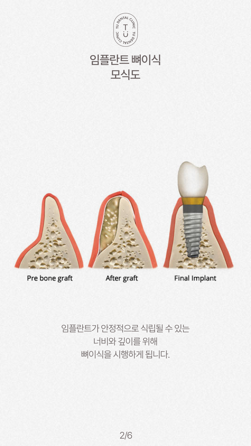 임플란트 뼈이식 꼭 해야할까요? 티유치과[TU치과] 관련 이미지 3