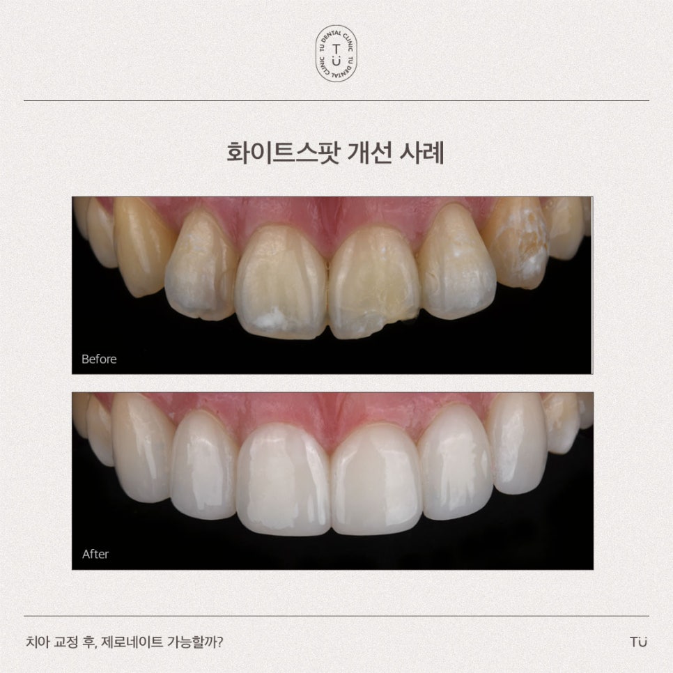 [티유치과] 치아 교정 후, 제로네이트 가능할까요?[TU치과] 관련 이미지 3